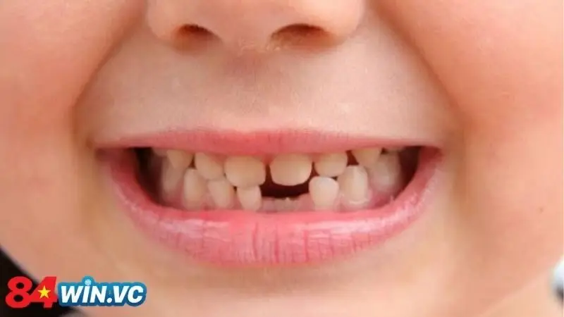 Khám phá tình huống nằm mơ thấy rụng răng